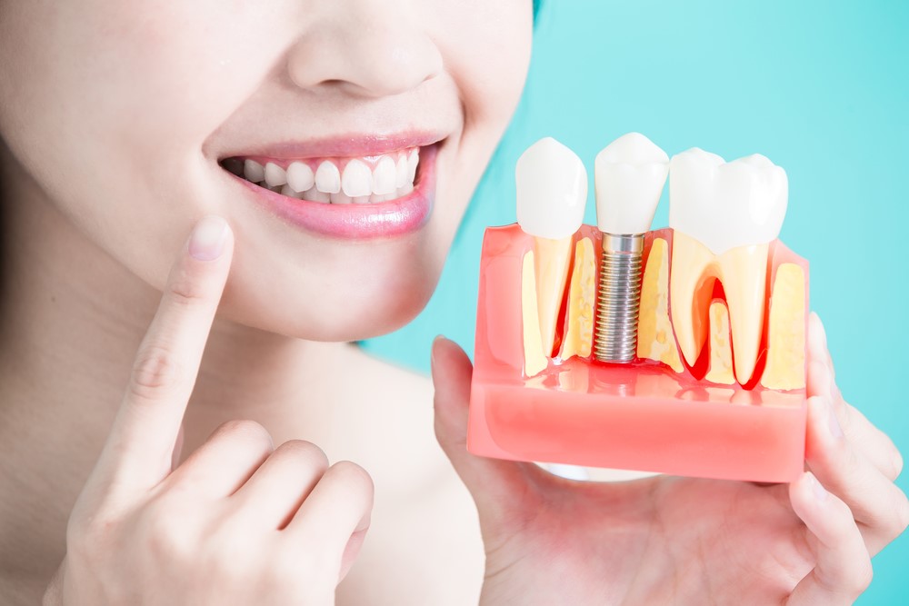răng implant