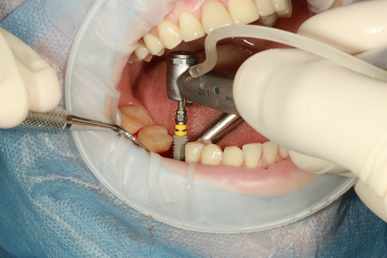 răng implant
