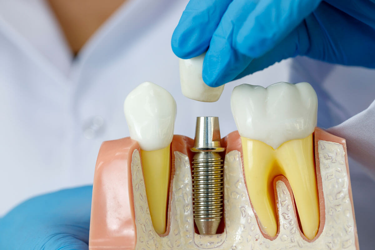 chi phí trồng răng implant