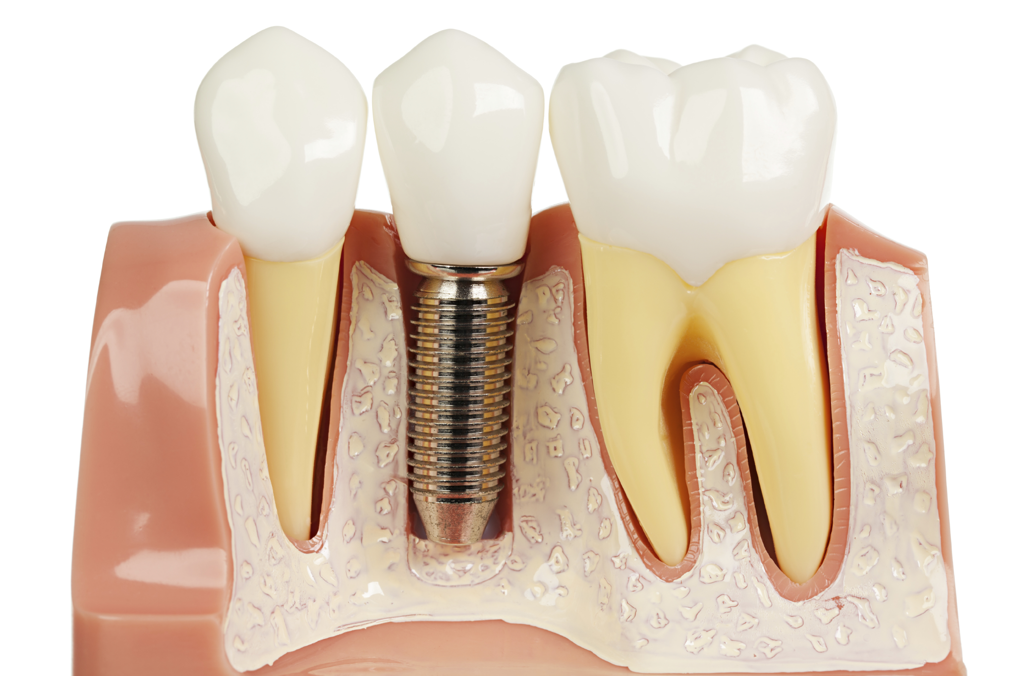 răng implant