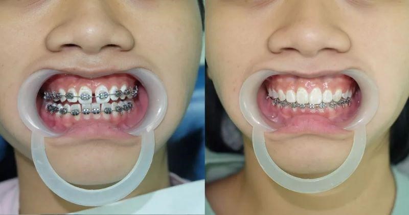 review niềng răng