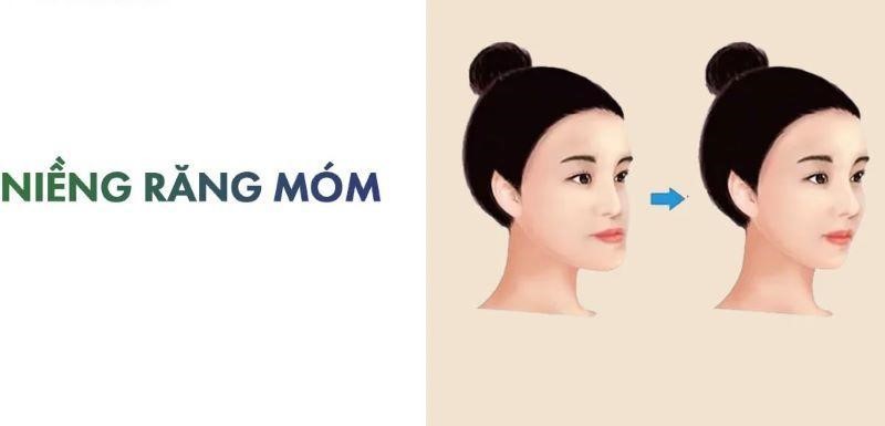 review niềng răng