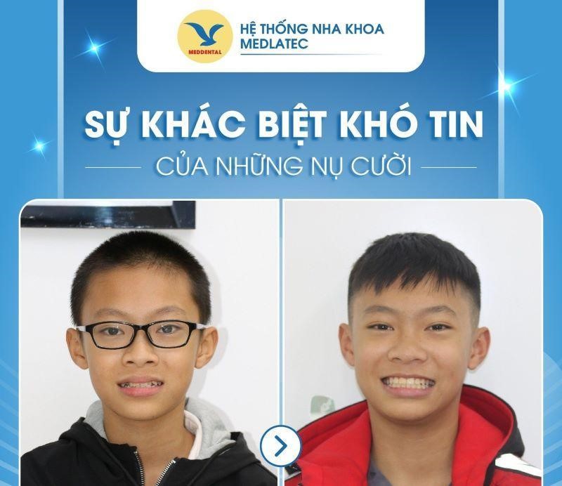 review niềng răng