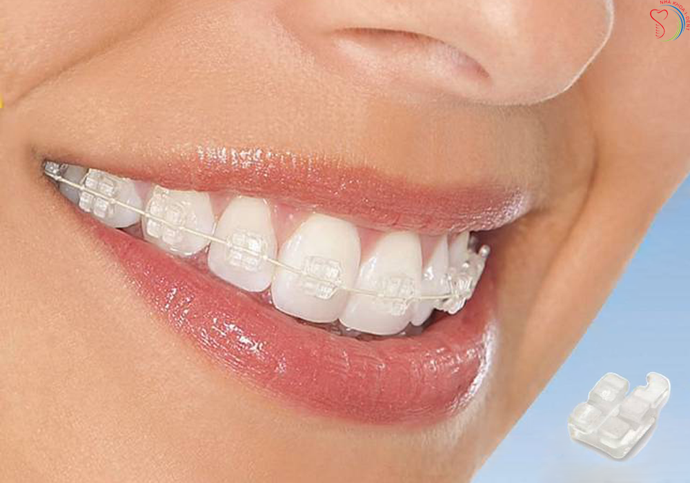 các loại mắc cài niềng răng