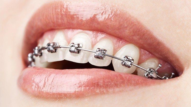 các loại mắc cài niềng răng
