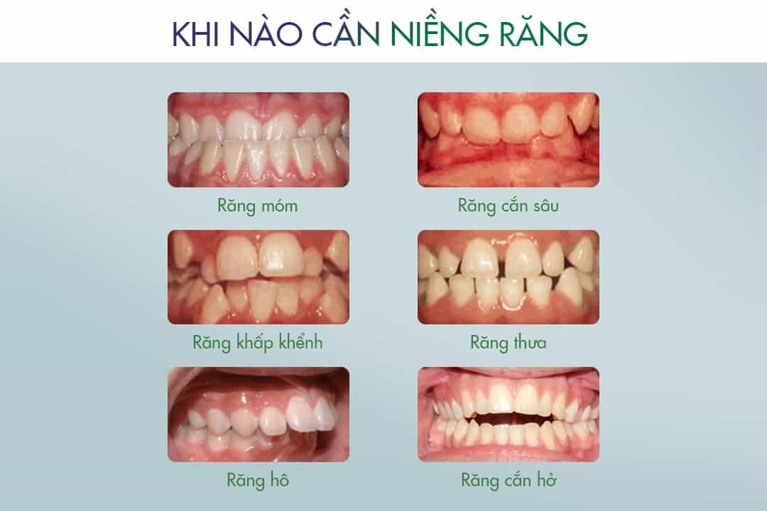 các loại mắc cài niềng răng