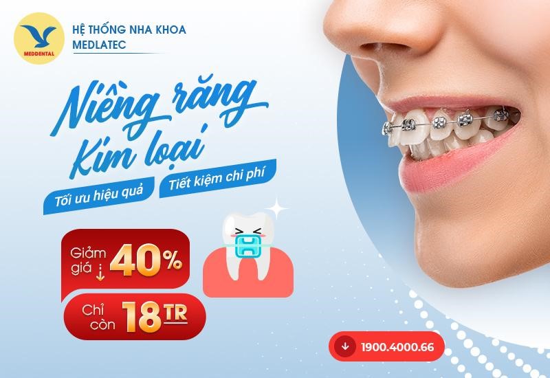 các loại mắc cài niềng răng