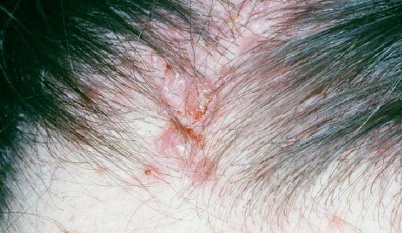 Da đầu nổi mụn