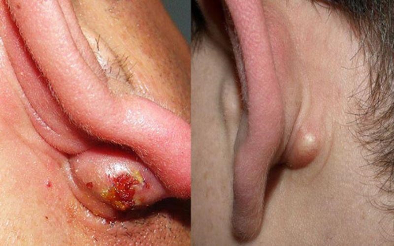  Mụn nhọt ở tai là một vấn đề da liễu thường gây khó chịu 