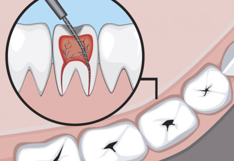 lấy tủy bọc răng sứ giá bao nhiêu