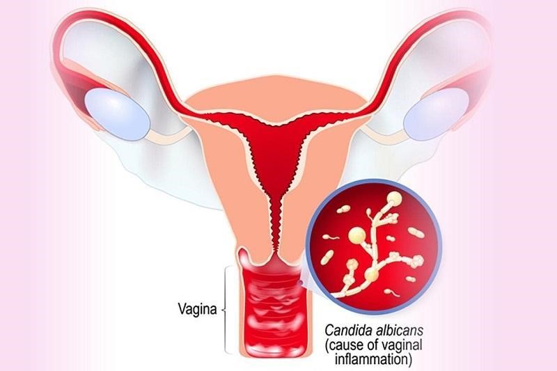 Nấm Candida có thể gây viêm nhiễm phụ khoa dẫn đến ngứa ngáy, khó chịu