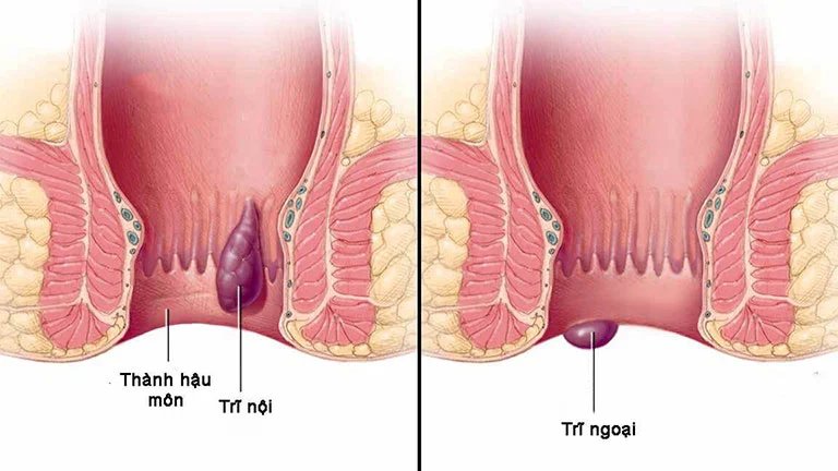 Mô phỏng trĩ nội trĩ ngoại